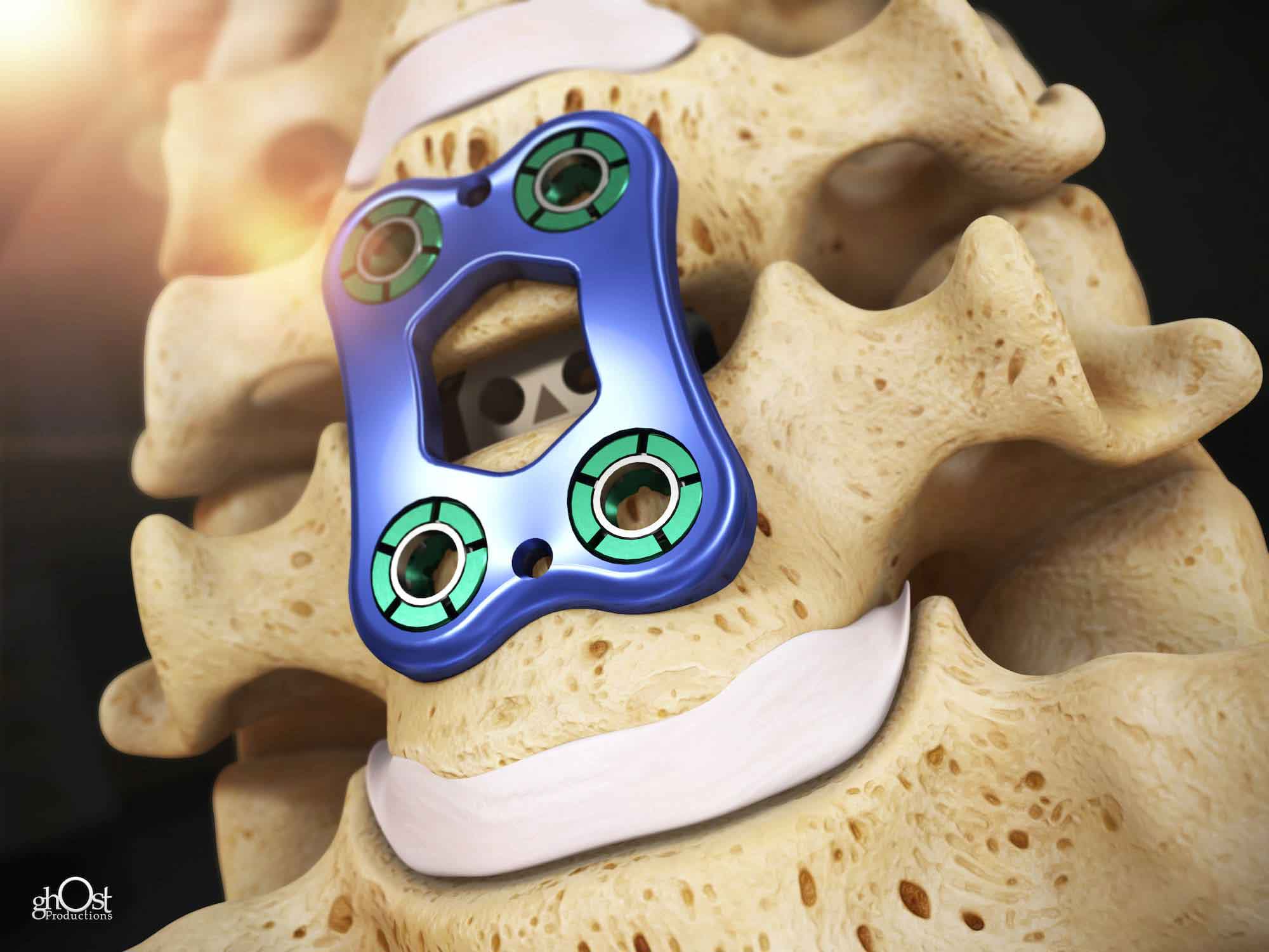 spinal implant device, improved mobility, pain relief, spinal conditions, targeted support, stability, chronic pain, limited mobility, active lifestyle, Aesculap, spinal health, orthopedics, neurosurgery, pain management, physical therapy, rehabilitation, spine surgery, intervertebral fusion, spinal stabilization, spinal cord injury, degenerative disc disease, herniated disc, scoliosis, spinal stenosis, osteoporosis, spinal trauma, spinal tumor.