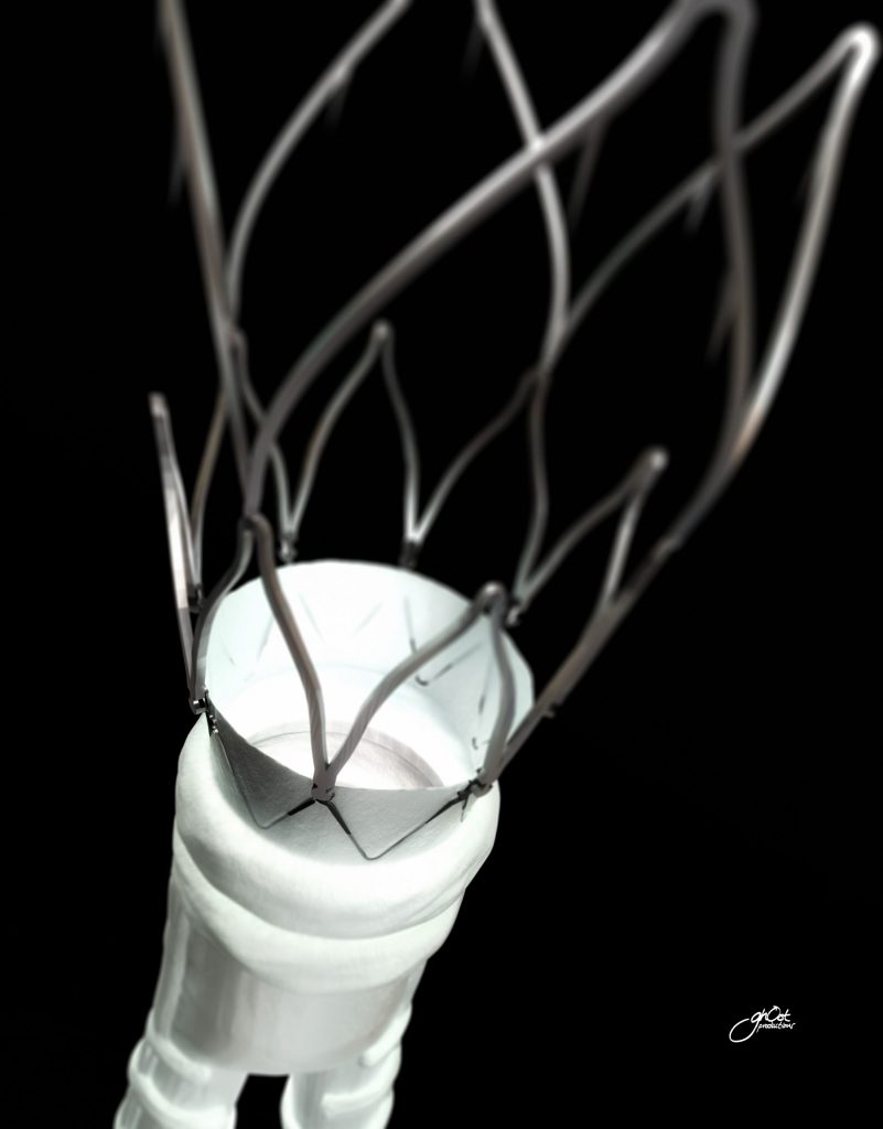 Medical illustration of the TriVascular Ovation Prime, an abdominal stent device for treating aortic aneurysms. The device is inserted into the abdominal area and expands to support the weakened aortic wall, reducing the risk of rupture. Created by Ghost Productions, this animation showcases the innovative technology behind this life-saving device. A game-changer in vascular surgery, the Ovation Prime offers hope to those suffering from aortic aneurysms.