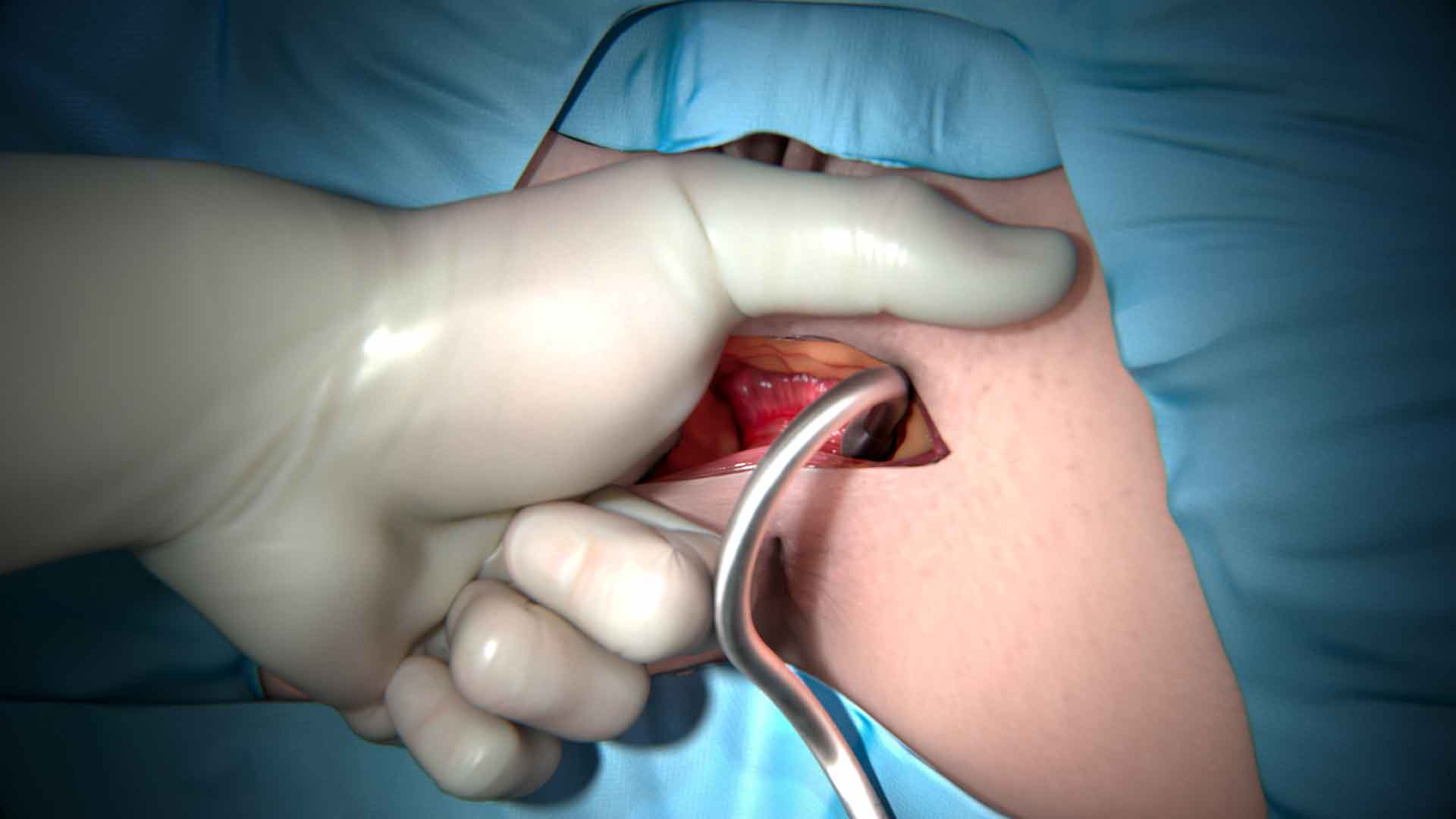 Fenix Continence Restoration System, FDA-approved implant, continence, fecal incontinence, implantation procedure, anal canal, magnets, sphincter muscles, magnetic beads, controlled passage of stool, accidental bowel leaks, surgical implant, Torax Medical, medical specialties: gastroenterology, colorectal surgery, urology, proctology, pelvic floor therapy.