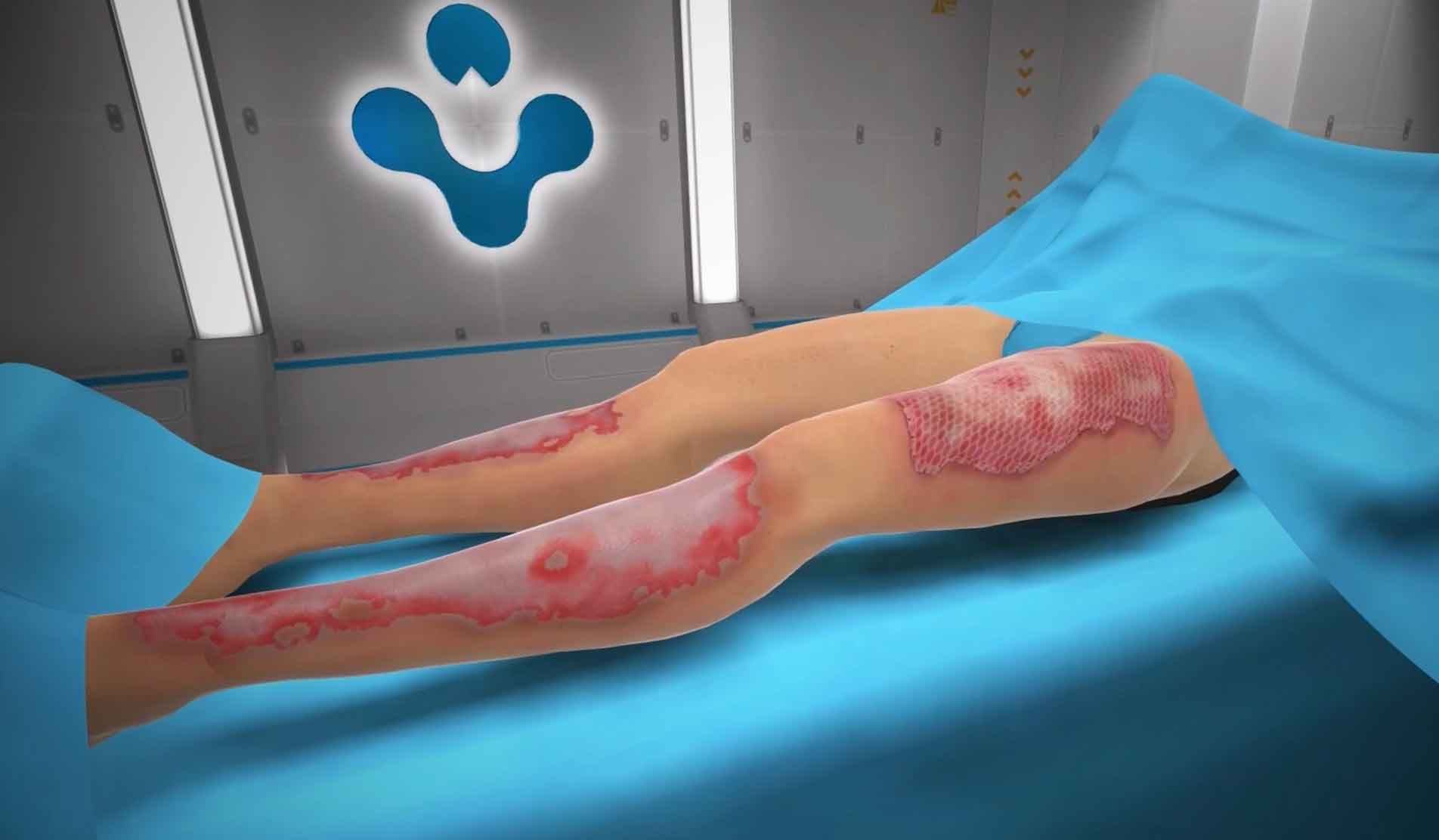 Ghost Medical has been working extensively alongside Avita to create an interactive VR training simulation to highlight their Recell system. Avita’s Recell system represents a significant advancement in the field of regenerative medicine and offers a promising new approach to the treatment of various skin burns and conditions. 