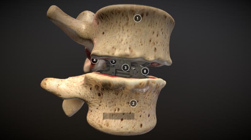 Spineology Expanding Lumbar Interbody Spacer