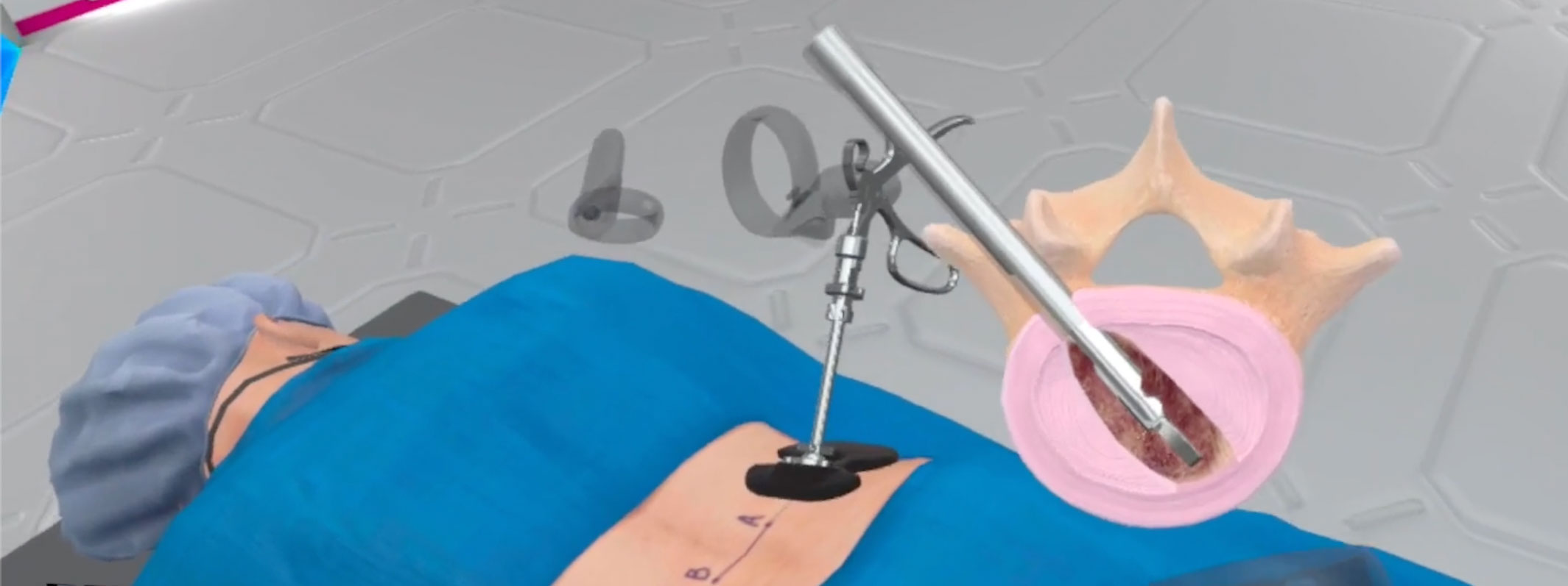 The access portal refers to the pathway that has been created through the soft tissues, muscle layers, and bone to reach the target disk space. VR