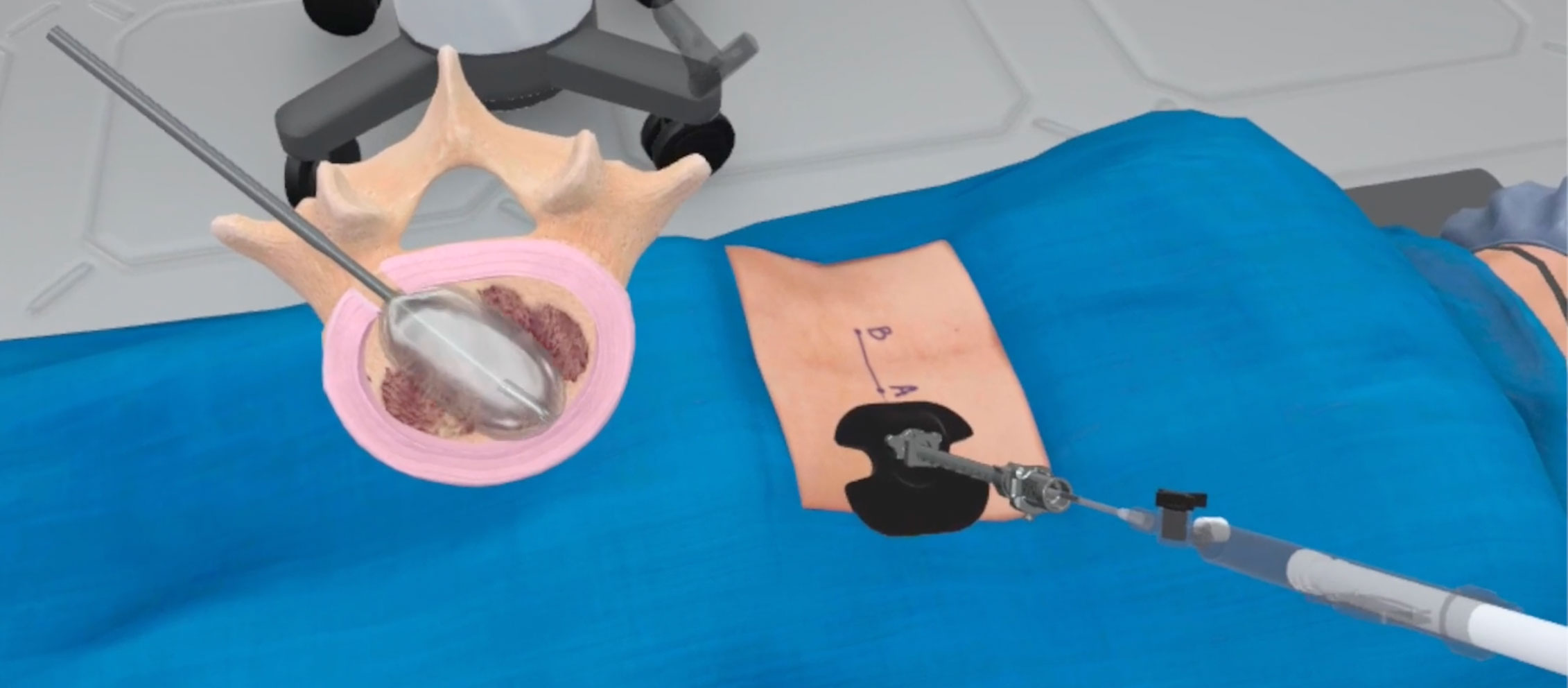 A deflated balloon catheter is carefully placed through a small access portal and into the space of the intervertebral disc. Spinal Fusion in VR