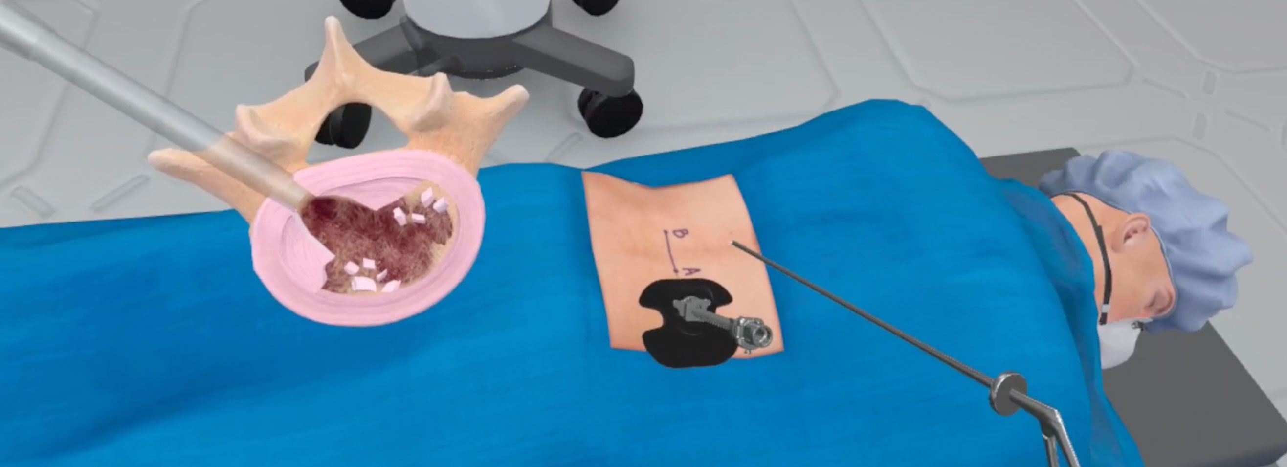 The discectomy step involves removing the damaged or herniated disk material. spine surgery in VR