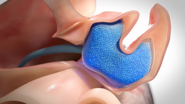 MIT, LAA occlusion, atrial fibrillation, shear-thinning micro-gel, alginate scaffold, cardiology animation, trans-septal catheter, implant biointegration, radiopaque gels, soft tissue occlusion, custom implant, hydrogel plug, collagen sock, device animation, stroke prevention