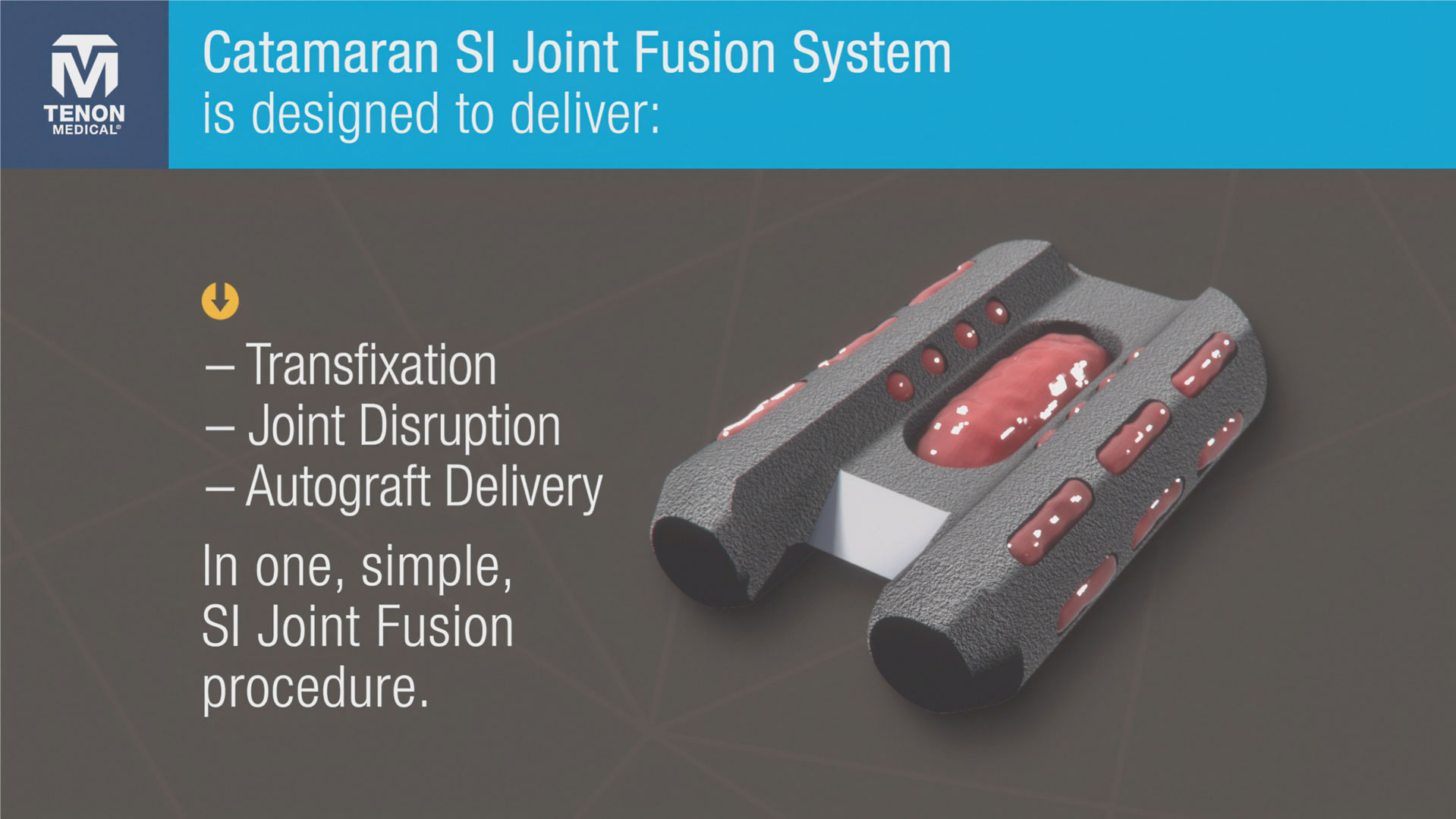 the Catamaran system streamlines the process by combining transfixtion, joint disruption, and autograft delivery into a single procedure.