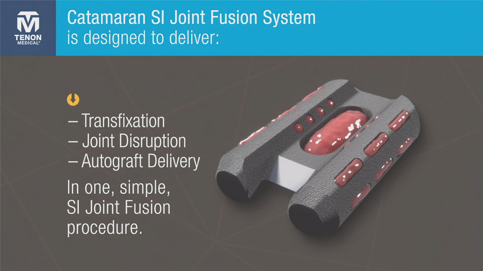 Tenon Medical's Catamaran SI Joint Fusion System represents a significant breakthrough in the field of orthopedics. Traditionally, SI joint fusion procedures required multiple steps and tools, making them time-consuming and complex.