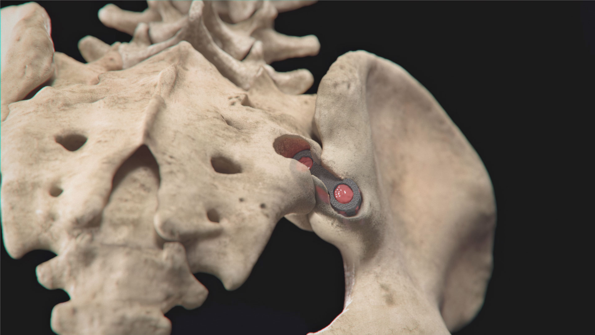 Medical illustration of Tenon Medical's Catamaran SI Joint Fusion System implementation highlights the accurate placement of the pontoon fixations into the ilium and the sacrum, ensuring the transfixion of the SI joint along its longitudinal axis.