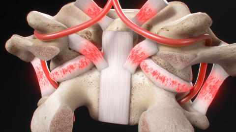  severe angular injury, spine, angular motion, spinal support ligaments, damage, nerve swelling, disc herniation, excessive translation, X-ray analysis, cranial junction, spinal instability, specialized stress X-rays, symptoms, diagnosis, treatment, healthcare professionals, patient outcomes