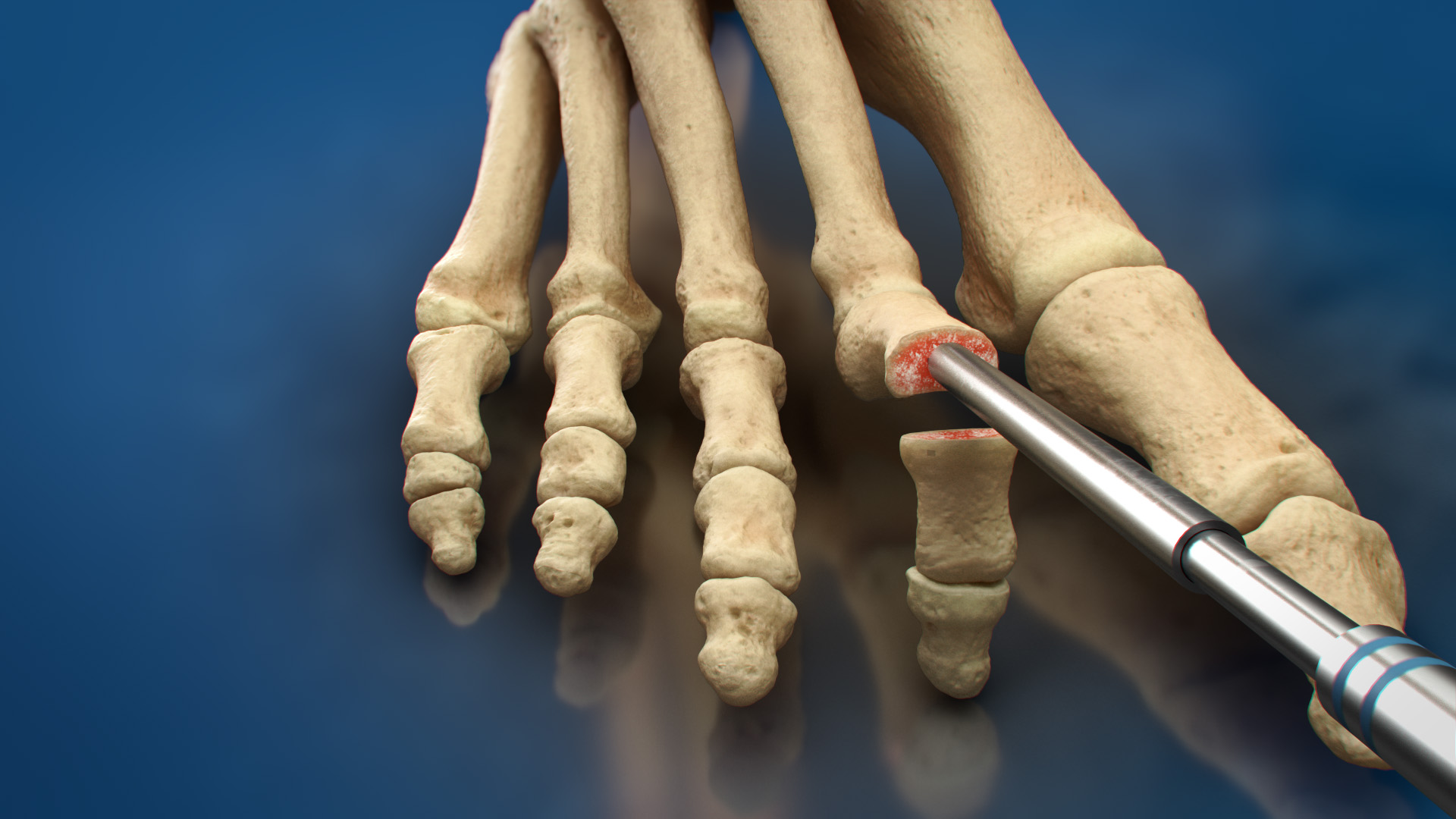  Toetal Solutions has meticulously engineered the ZipToe™ Hammertoe System with ambulatory surgery centers (ASCs) in mind