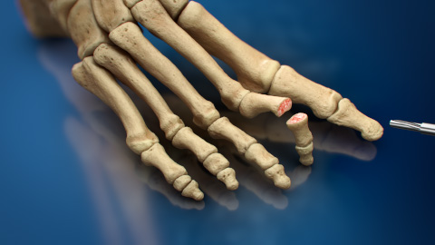 ZipToe™ System - Treatment of Rigid Hammertoe Deformities