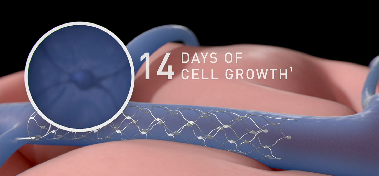 Strategically positioned near the motor cortex, the part of the brain responsible for motor functions, the sensors in the Stentrode receive brain signals related to intended movements.