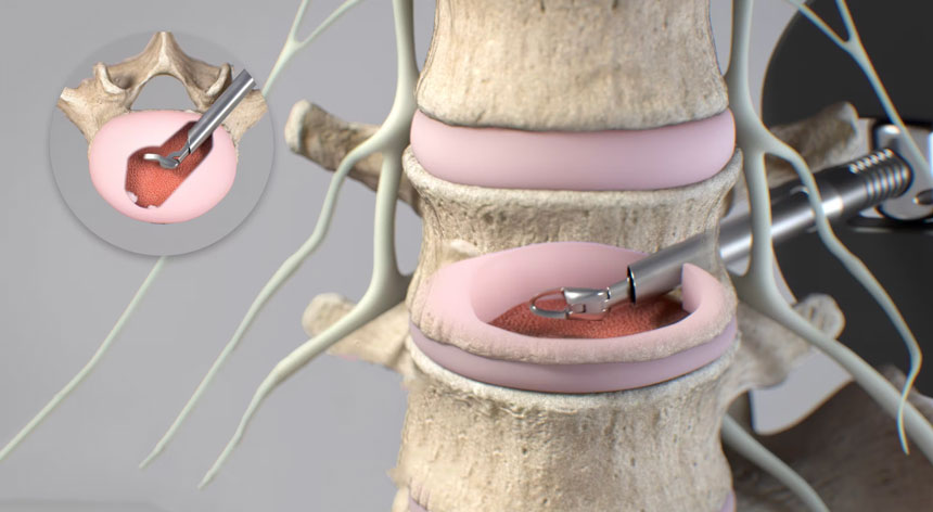 OptiLIF® Endo System Surgical Animation  - Spineology