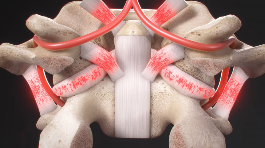 Severe Angular Injury to the Spine Orthopedic Animation - Spinal Kinetics