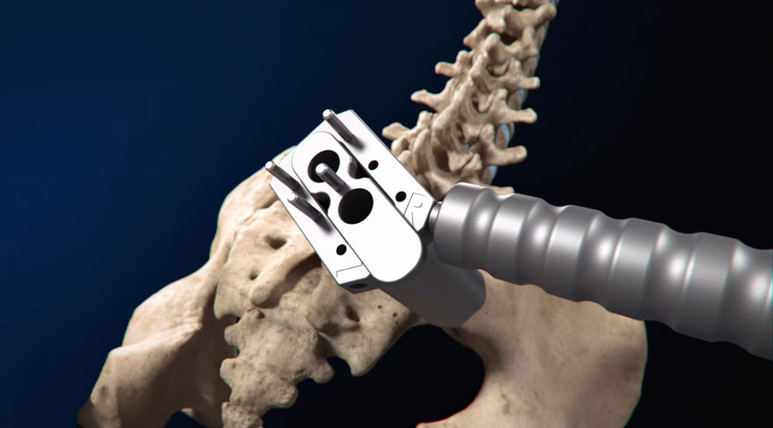 The Catamaran SI Joint Fusion System - Tenon Medical | Video