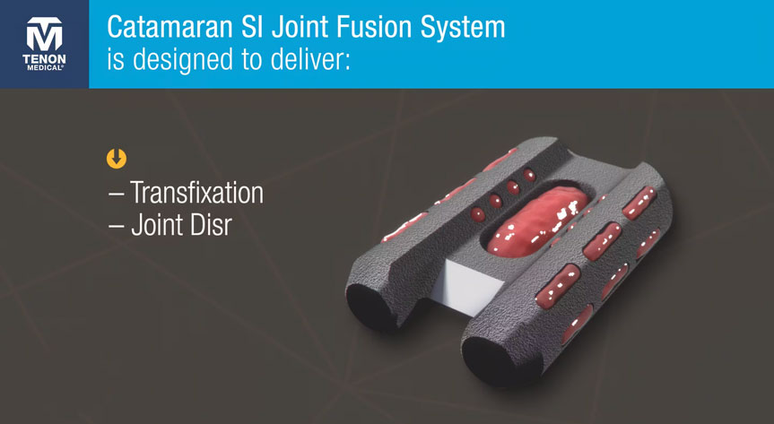 Catamaran SI Joint Fusion Device Overview - Tenon Medical