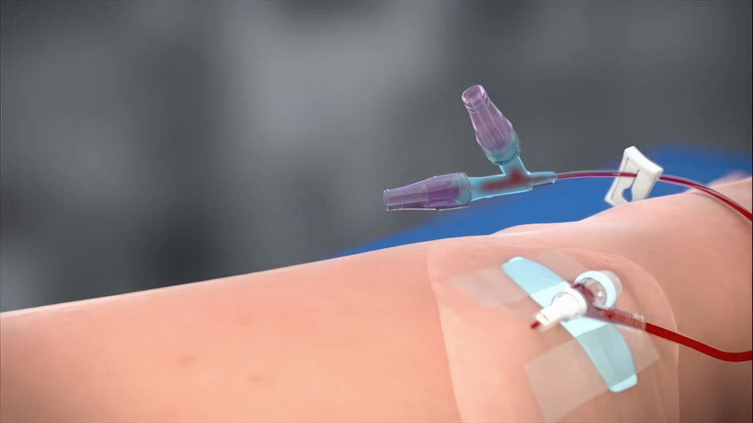 The Smiths Medical DeltaVen is an infusion therapy product for hemodialysis treatment. It's designed by a global medical technology company, Smiths Medical. DeltaVen is an essential tool for healthcare professionals treating patients with kidney failure. It provides precise and reliable infusion therapy for effective condition management. This product is a must-have for any medical facility committed to delivering high-quality care to patients.