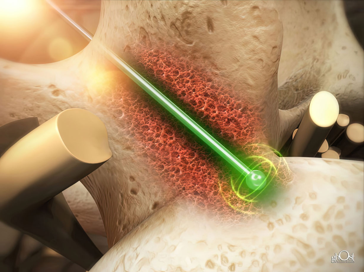 Illustration of Sentio MMG, a device that assists surgeons in locating and mapping motor nerves during surgical procedures. The device uses mechanomyographic signals and electrical stimulus of nerves to provide real-time information to the surgeon, allowing for improved procedural efficiency and reduced cost of care. It features accelerometer-based sensors, eliminating the risk of needle stick injury, and offers confirmation of nerve location with high sensitivity and specificity. Revolutionize surgical procedures with Sentio MMG.