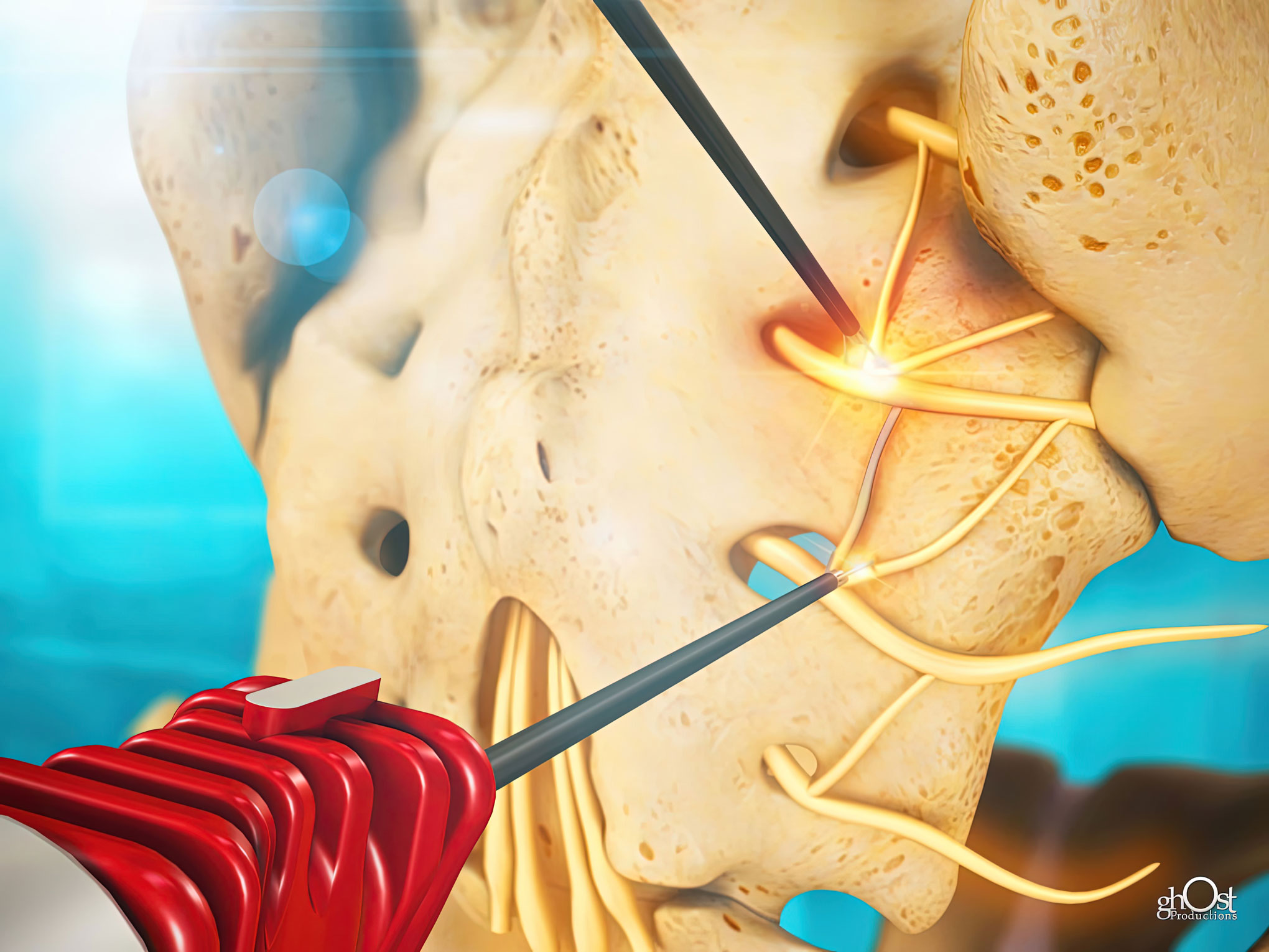 Illustration of NimbusRF Electrode, a medical device by Nimbus Concepts that helps alleviate patient pain during radiofrequency thermal neurotomy procedures. Ghost Productions created an animation to showcase its innovative design and functionality. Advanced technology makes this electrode a must-have for medical professionals seeking to provide patients with the best care and comfort.
