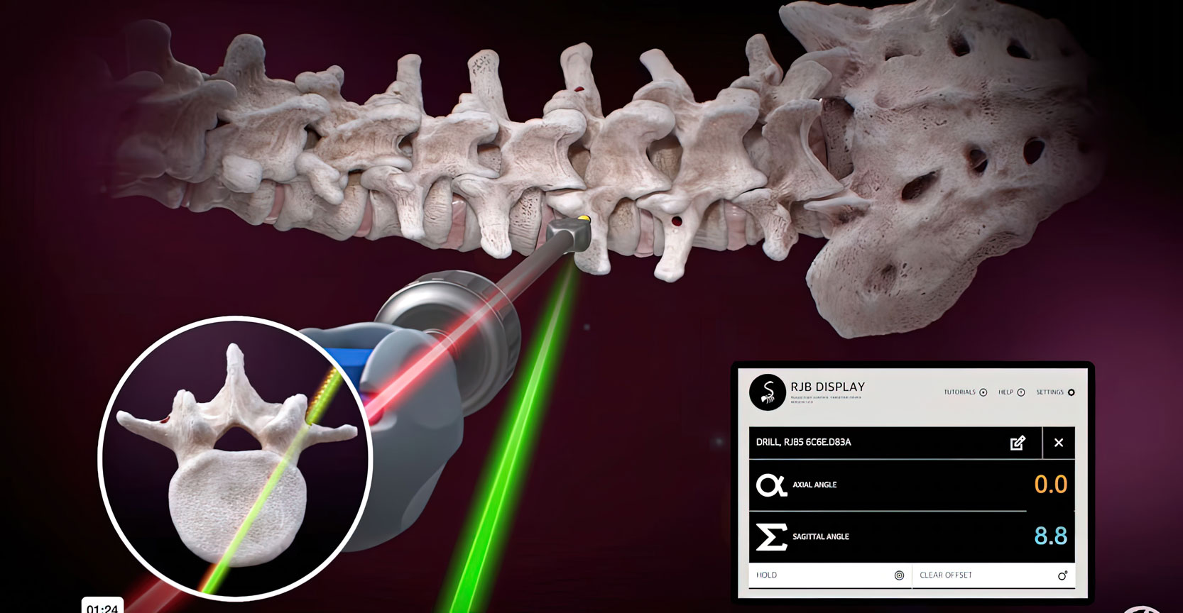 A medical illustration showing the Ruthless Spine RJB Surgical Navigation technology. The technology provides an objective measurement of screw trajectory for precise screw placement during surgery. This improves surgical outcomes and reliability. Trust in the precision of Ruthless Spine RJB surgical navigation for your next procedure.