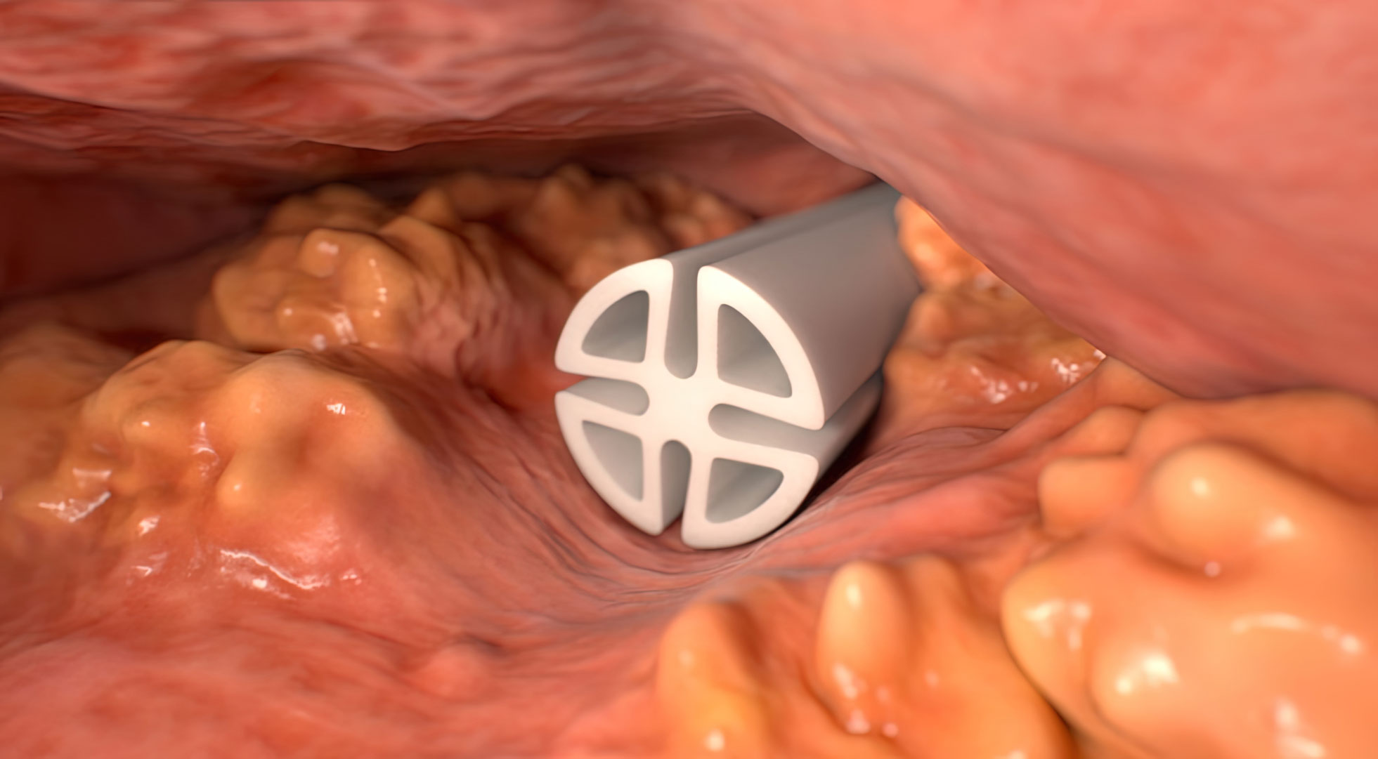 This medical animation showcases the Hemaduct line of wound drains. It provides a detailed look at the construction and configuration of the drain and drainage ducts. The Hemaduct wound drains are shown in context with a typical wound, demonstrating their effectiveness in remaining clear and continuing to drain fluids without clogging. The animation also highlights the ability of Hemaduct® Wound Drains to allow multiple fluid pathways, even if soft tissue obstructions restrict continuous fluid flow. The drain is comprised of both open and closed channels that are interconnected by internal portals, which allow fluid to change channels and find alternative pathways around obstructions. This visually compelling and descriptive animation is an excellent resource for medical device marketing and education.