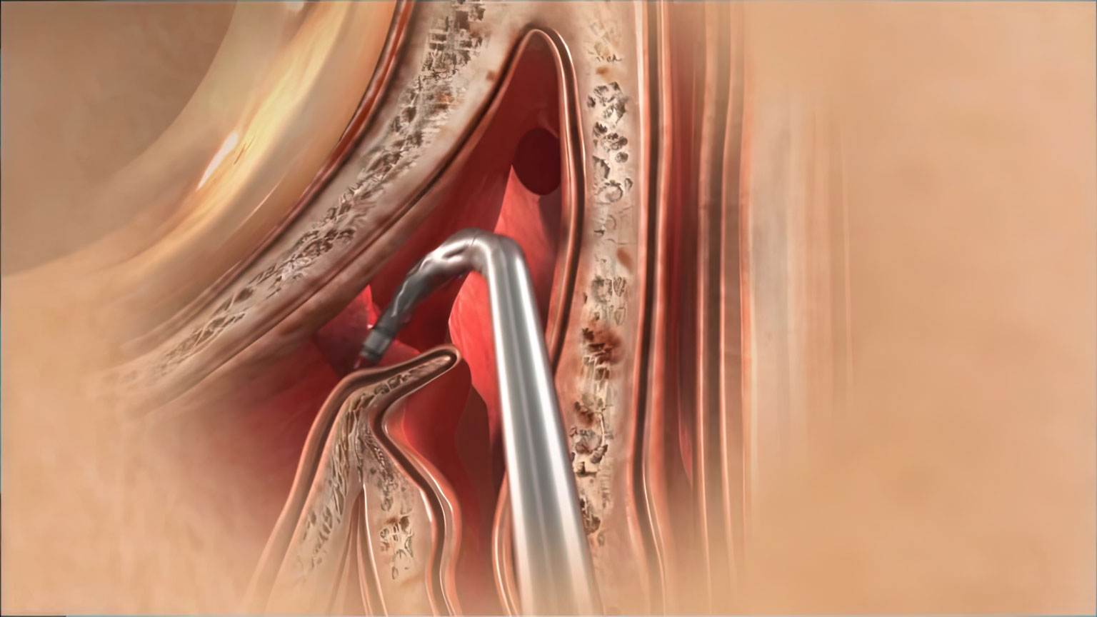 Animation of Medtronic NuVent Sinus Dilation System with inflatable balloon tip opening sinus cavity. Created by Ghost Productions. Helps medical professionals and patients understand system's benefits.