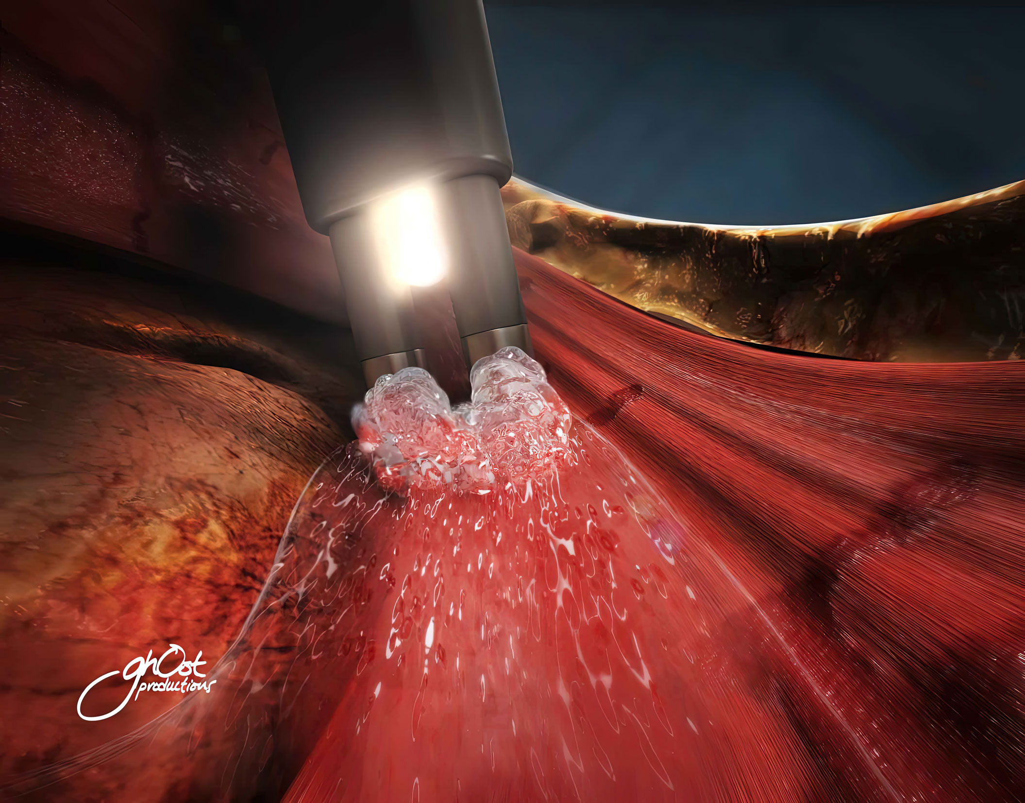 Animation showcasing the Aquamantys System by Salient Surgical for hemostatic sealing of soft tissue and bone. The system uses radiofrequency energy and saline for precise and effective sealing, improving patient outcomes.