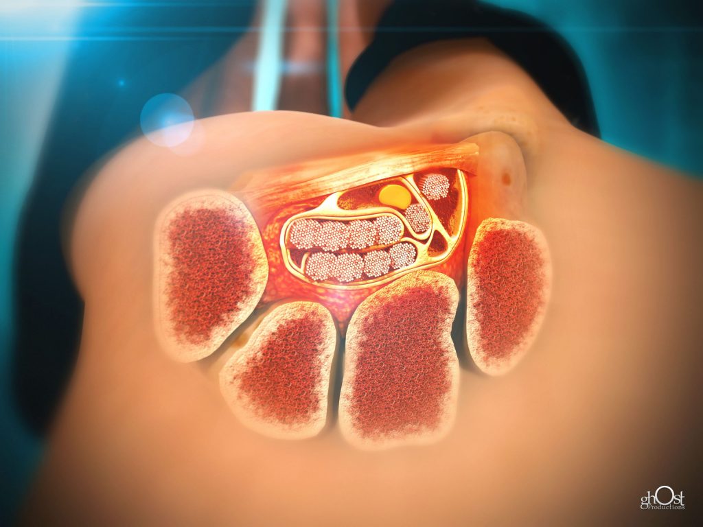 Animation showcasing Keo Brace, a device for treating Carpal Tunnel Syndrome. Features and benefits explained in detail. Useful for medical professionals and patients.