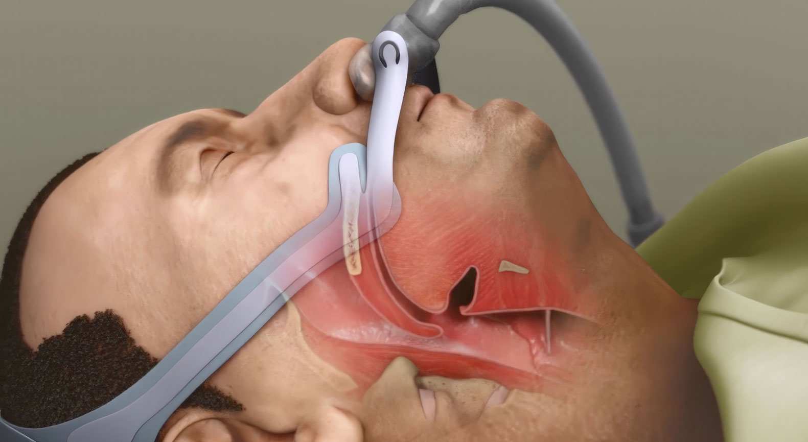 Animation explaining sleep apnea and benefits of CPAP mask. Shows pathology of sleep apnea and how it affects breathing during sleep. Highlights advantages of using CPAP mask to alleviate symptoms and improve overall health. Created by Ghost Productions for Mayo Clinic. Valuable tool for learning about sleep apnea and treatment options.