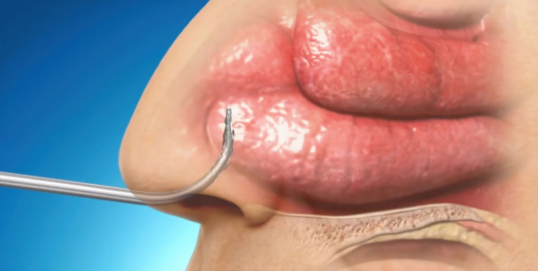 The NuVent Sinus Dilation System by Medtronic is a solution for sinus relief. It features an inflatable balloon tip to open up patients' sinus cavities, providing relief from sinus-related discomfort. It's safe and effective for chronic sinusitis and other sinus-related issues. Try it today for improved quality of life.