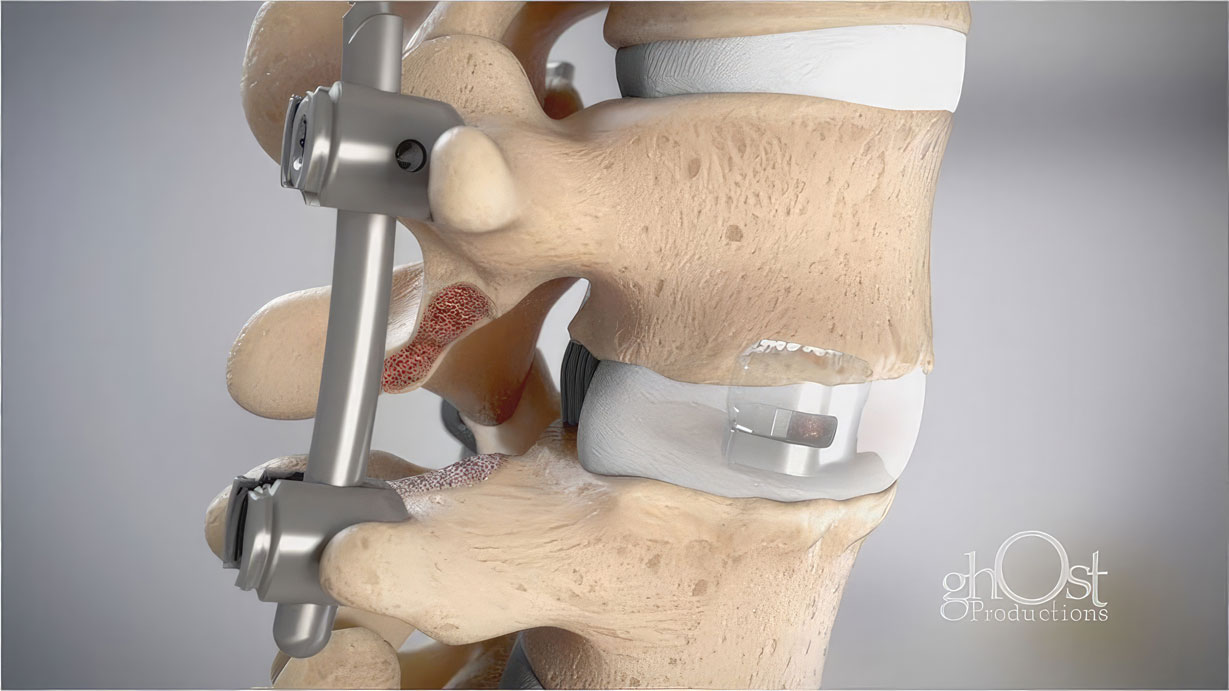 This medical animation showcases the Unleash MIS TLIF System, a spine technology developed by DePuy Synthes. The animation highlights the VIPER Prime system, which provides an all-in-one solution for minimally invasive surgery transforaminal lumbar interbody fusion (MIS TLIF). The animation demonstrates how the UNLEASH MIS TLIF Solution improves the three key stages of the procedure: discectomy with the CONCORDE Clear MIS Discectomy Device, cage placement with PROTI 360° Integrated Technology, and screw placement with the VIPER PRIME System. This animation is an excellent resource for medical professionals and patients.