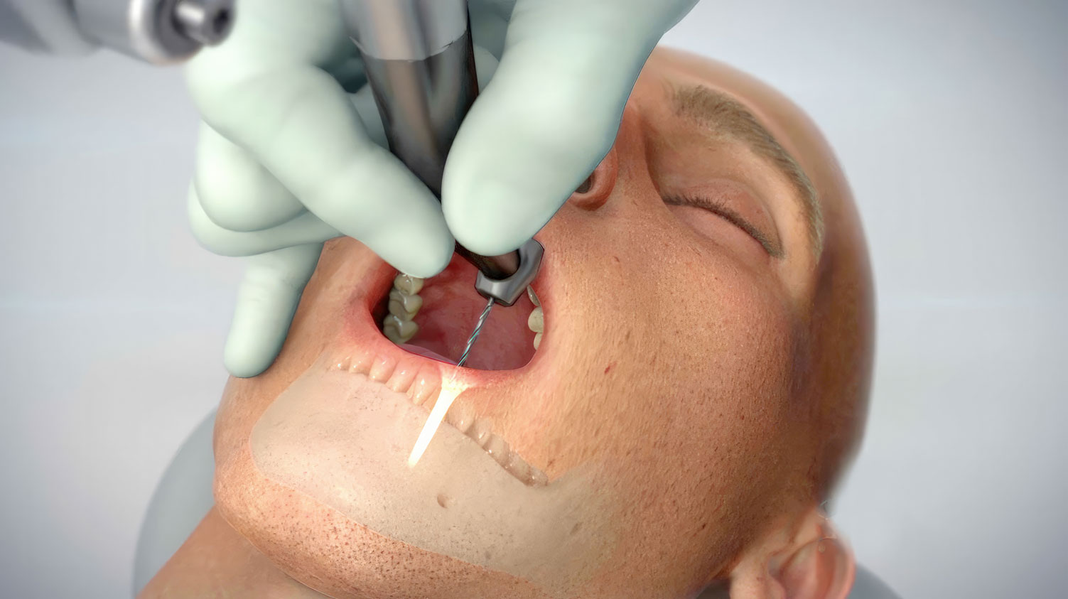 Neocis YOMI Robotic Guidance System for dental implant surgery. Offers precise and accurate placement with dynamic planning software and a collaborative robotic arm. Provides real-time adjustments and visual feedback for optimal results. Trust in Neocis and YOMI for the best outcome.