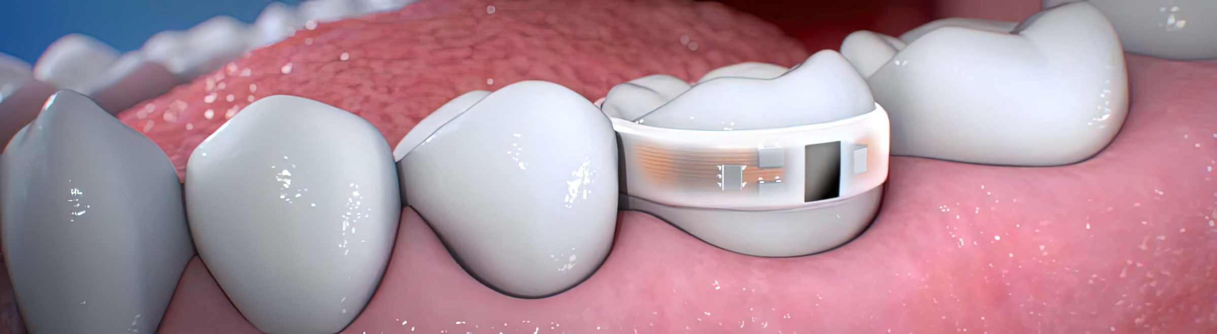 Lura Health's U-CHU Device is a wearable salivary diagnostic sensor that monitors the acid levels in your mouth. It provides real-time data to the U-CHU APP, which sends personalized product recommendations to neutralize acid and prevent tooth decay. This device revolutionizes dental health and helps you take control of your oral health.