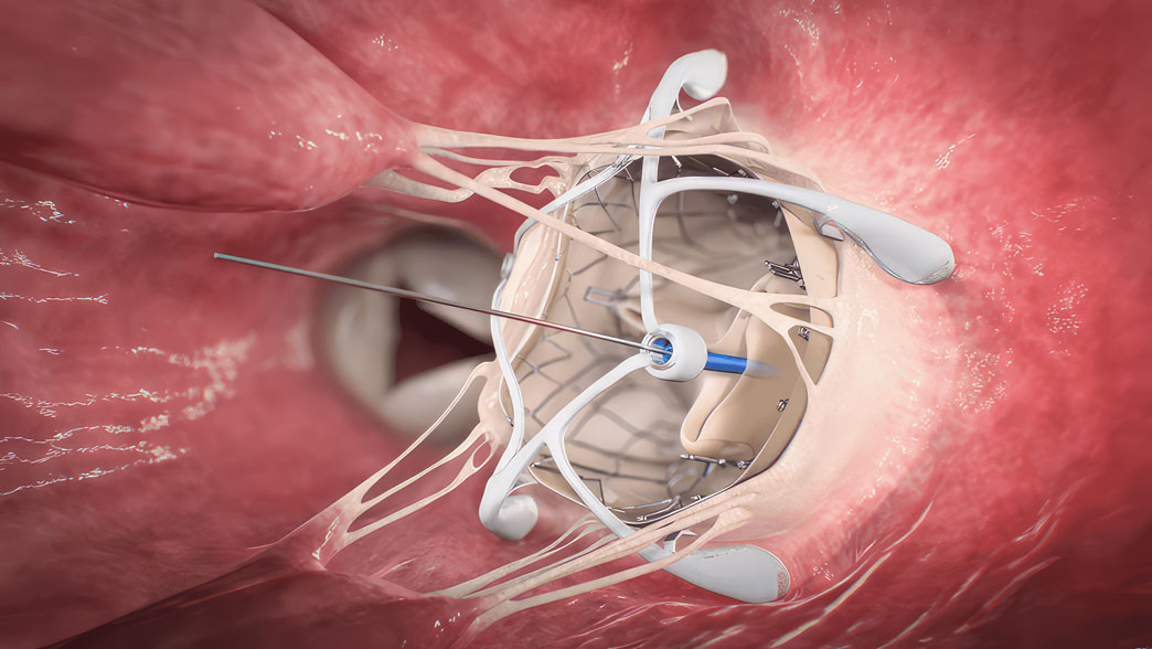 Minimally invasive mitral valve replacement surgery illustration. Shows replacement of malfunctioning valve with artificial valve without invasive open heart surgery. Innovative and safe technique revolutionizing cardiac surgery for faster recovery.