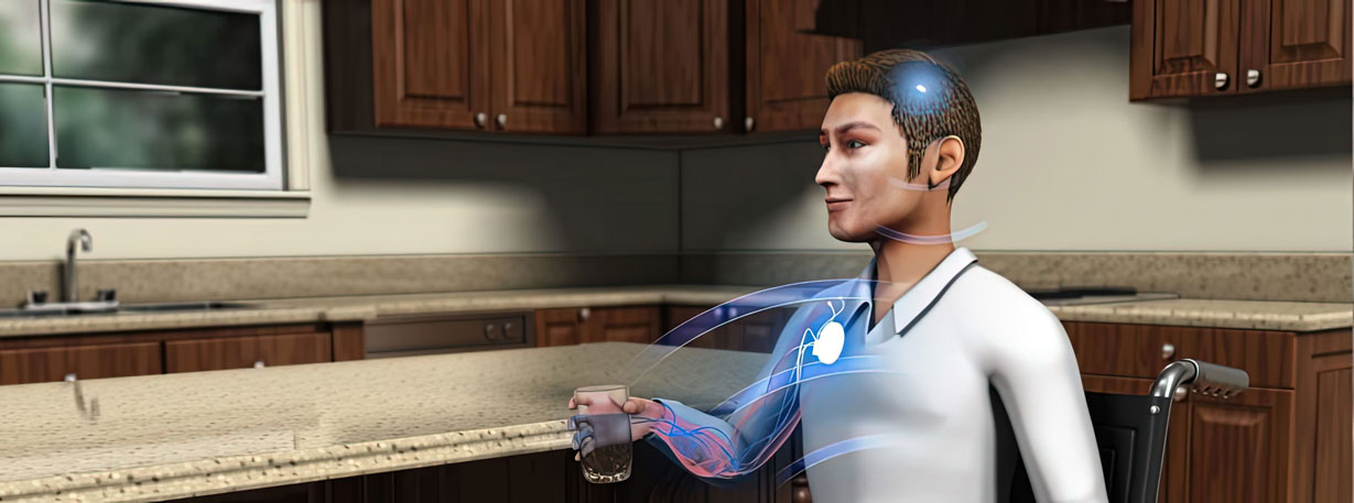 A medical illustration of the Synchron Stentrode, a neural interface that creates a digital bypass from the brain to an assistive device, allowing direct brain control of devices such as a mouse, keyboard, or vehicles. This technology offers hope to those suffering from paralysis by restoring independence and freedom.