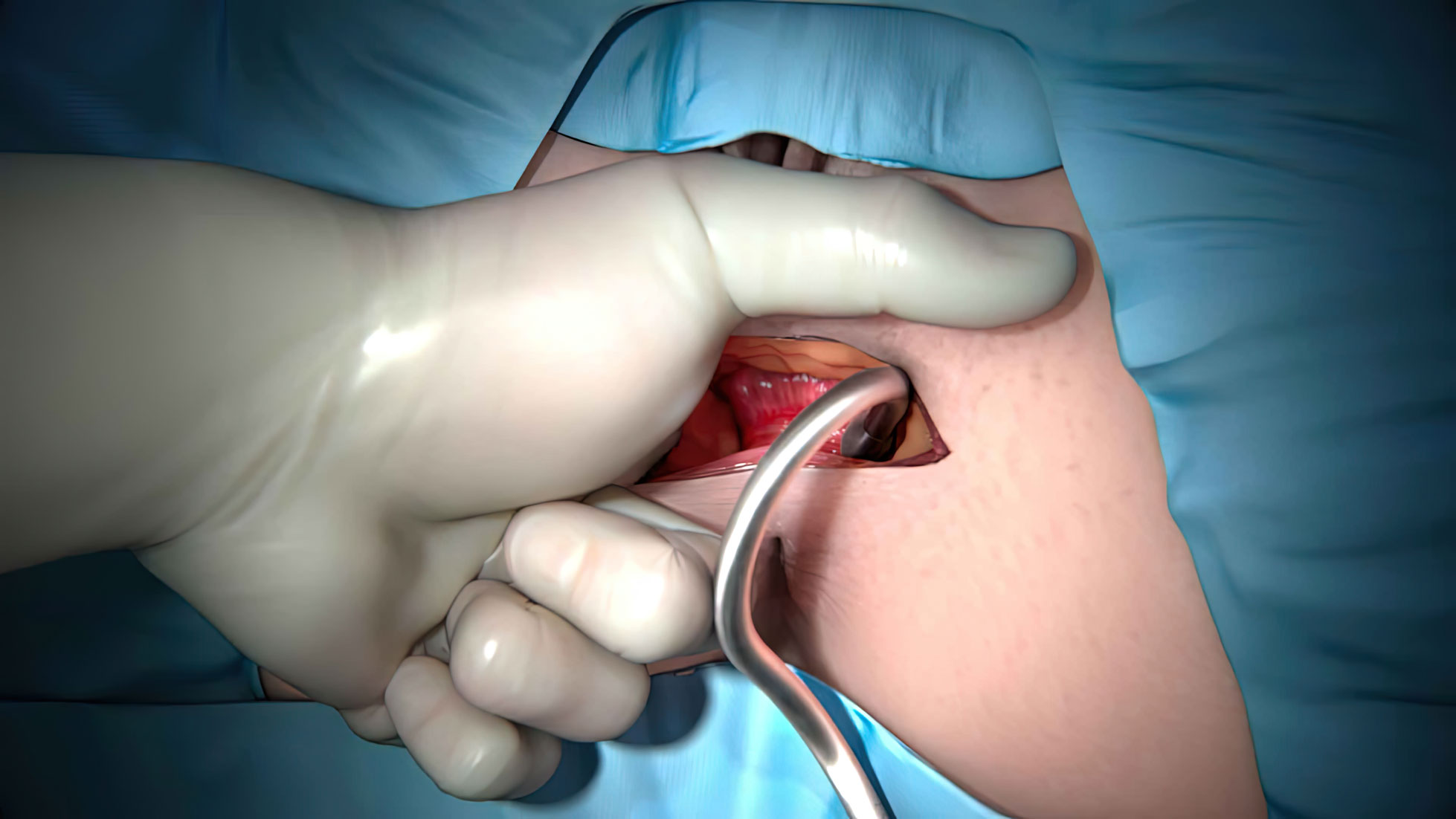 The Fenix Continence Restoration System is an FDA-approved implant for restoring continence in people with fecal incontinence. It involves inserting a flexible ring of magnets into the anal canal to strengthen weak sphincter muscles. The magnetic beads separate for stool to pass and then close to prevent leaks. Safe and effective solution for fecal incontinence.