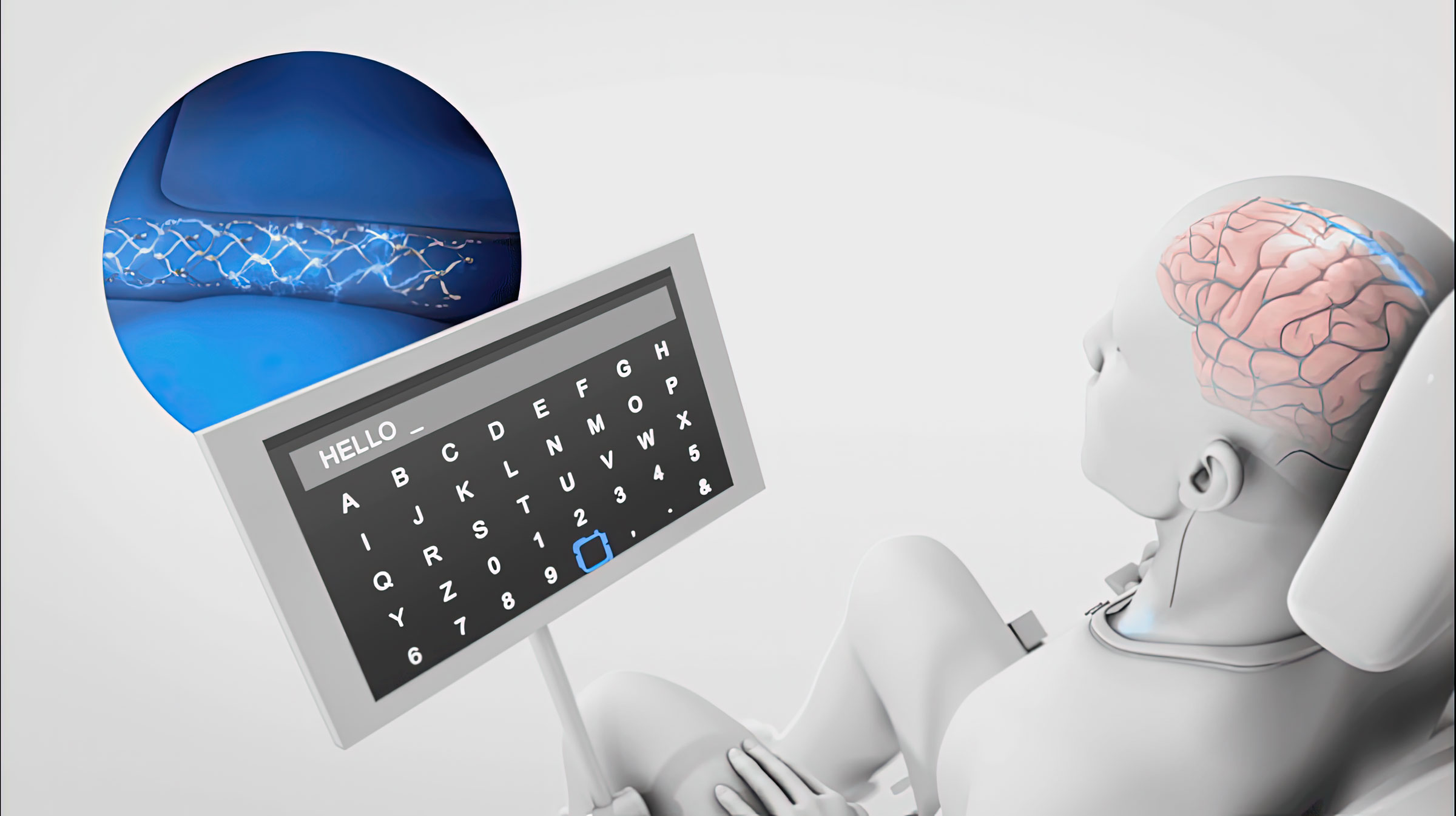 Revolutionary Neural Interface: Synchron's Stentrode™ for Paralysis and Direct Brain Control of Devices. This cutting-edge technology creates a digital bypass from the brain to an assistive device, allowing individuals with paralysis to regain control and independence. The Stentrode™ enables direct brain control of devices such as a mouse, keyboard, and vehicles, offering a new level of freedom and mobility. Join the revolution and discover the power of Synchron's Stentrode™ today.