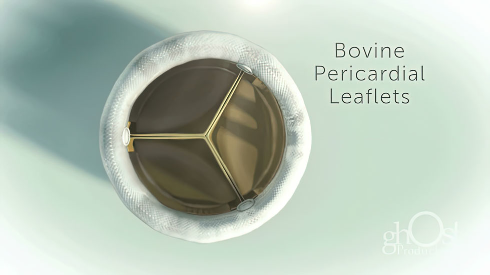 High-quality bovine pericardial leaflets, specifically designed for cardiovascular surgery. Sourced and processed for optimal performance and durability. Essential in a range of surgical procedures. Superior quality and reliability make them an excellent choice for surgeons seeking best outcomes for patients.