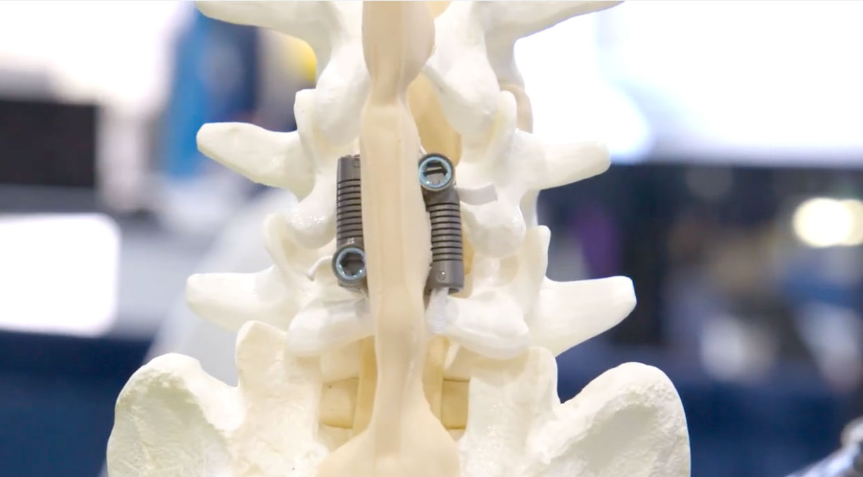 LimiFlex's Dynamic Sagittal Tether™ Revealed at NASS 2023