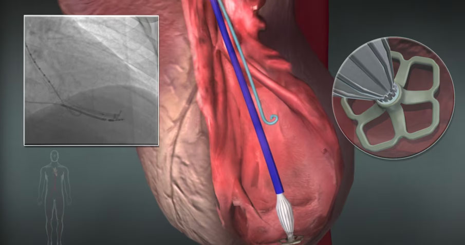 Heart Failure Treatment with PARACHUTE® | CardioKinetix | Video