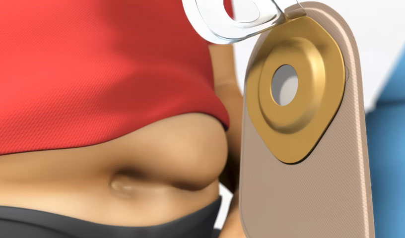Hollister Moderma Flex: Ostomy Solutions | 2014 Animation | Video
