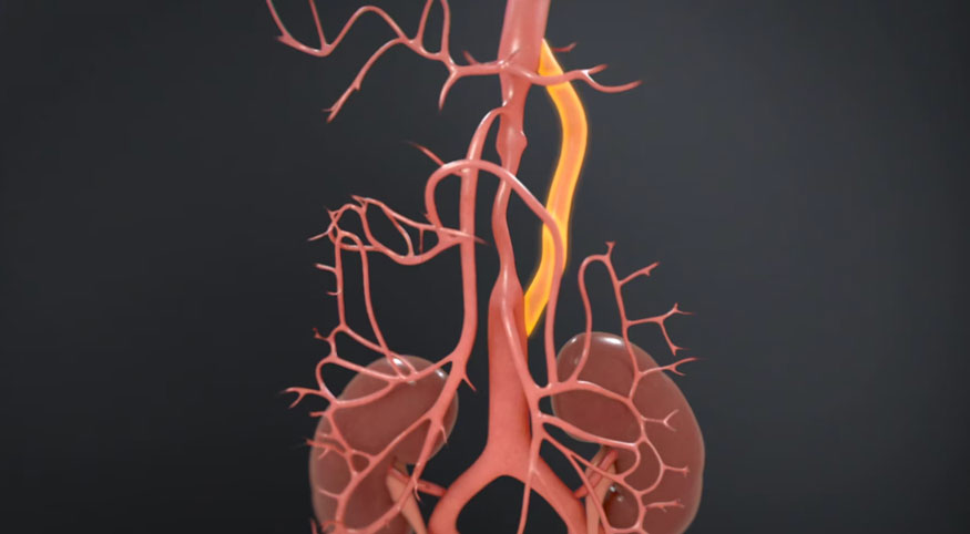 Mesenteric Artery Growth to Improve Circulation ( Magic ) Procedure | Boston’s Children Hospital