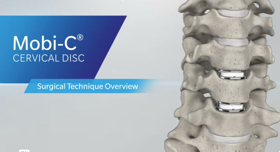 Mobi-C Cervical Disc Overview | ZimVie Spine 2016 Orthopedic Animation