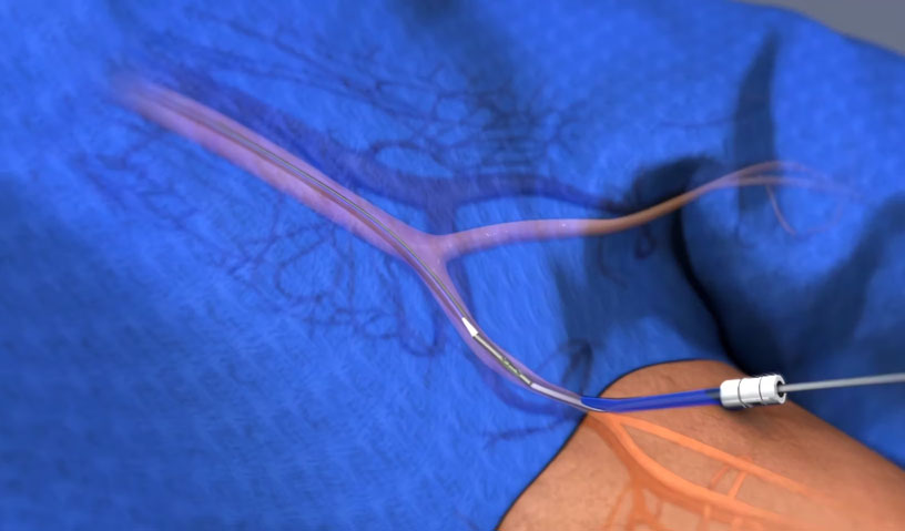 Discover the groundbreaking NobleStitch EL device in action through this captivating animation provided by Ghost Medical Animation. Explore how HeartStitch® is reshaping the landscape of vascular and cardiovascular procedures, with a commitment to transforming cardiac surgery and interventions in the next decade.