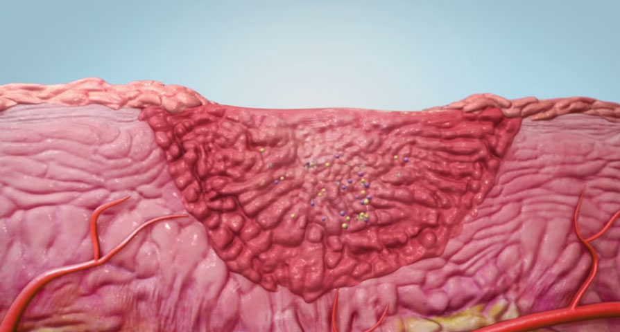 Explore Osiris Therapeutics, Inc.'s groundbreaking approach to wound healing using advanced cellular regenerative products in this visually compelling medical animation by Ghost Productions. Founded in 1992, Osiris is a pioneer in adult stem cell therapy for tissue regeneration, addressing the rising healthcare issue of chronic wounds, including debilitating diabetic foot ulcers.
