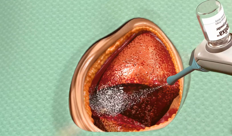 Raplixa™ Fibrin Sealant Powder for Surgical Haemostasis | 2016  | Video