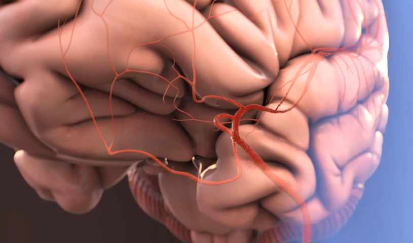 Stryker AXS Offset Delivery Assist Catheter Clot Retrieval Procedure | 2018 Animation