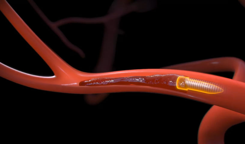 Stryker AXS Universal Next-Gen Thrombus Aspiration Device  | Video