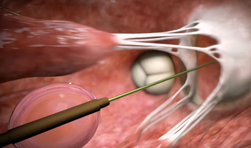 Explore the groundbreaking Tendyne™ Transcatheter Mitral Valve Replacement device in this captivating animation by Ghost Medical Animation. Abbott, a pioneer in diagnostics, medical devices, nutrition, and pharmaceuticals, presents this revolutionary TMVR option for patients with symptomatic, significant MR (≥ grade 3).