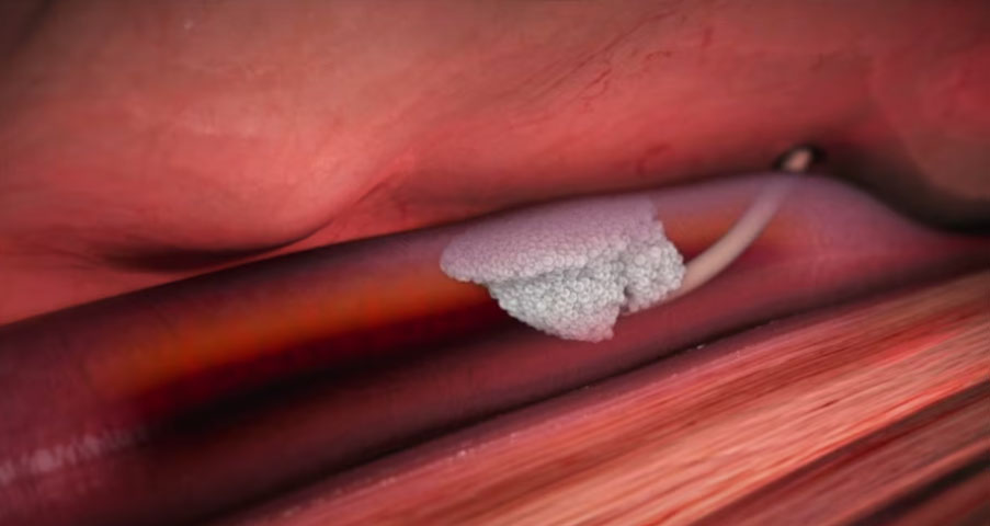 Varithena Treatment for Venous Insufficiency | 2012 Animation | Video